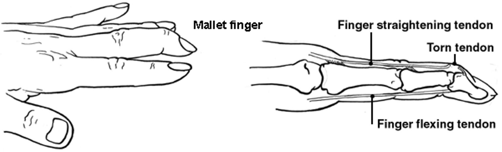 Diagram of the hand showing mallet finger