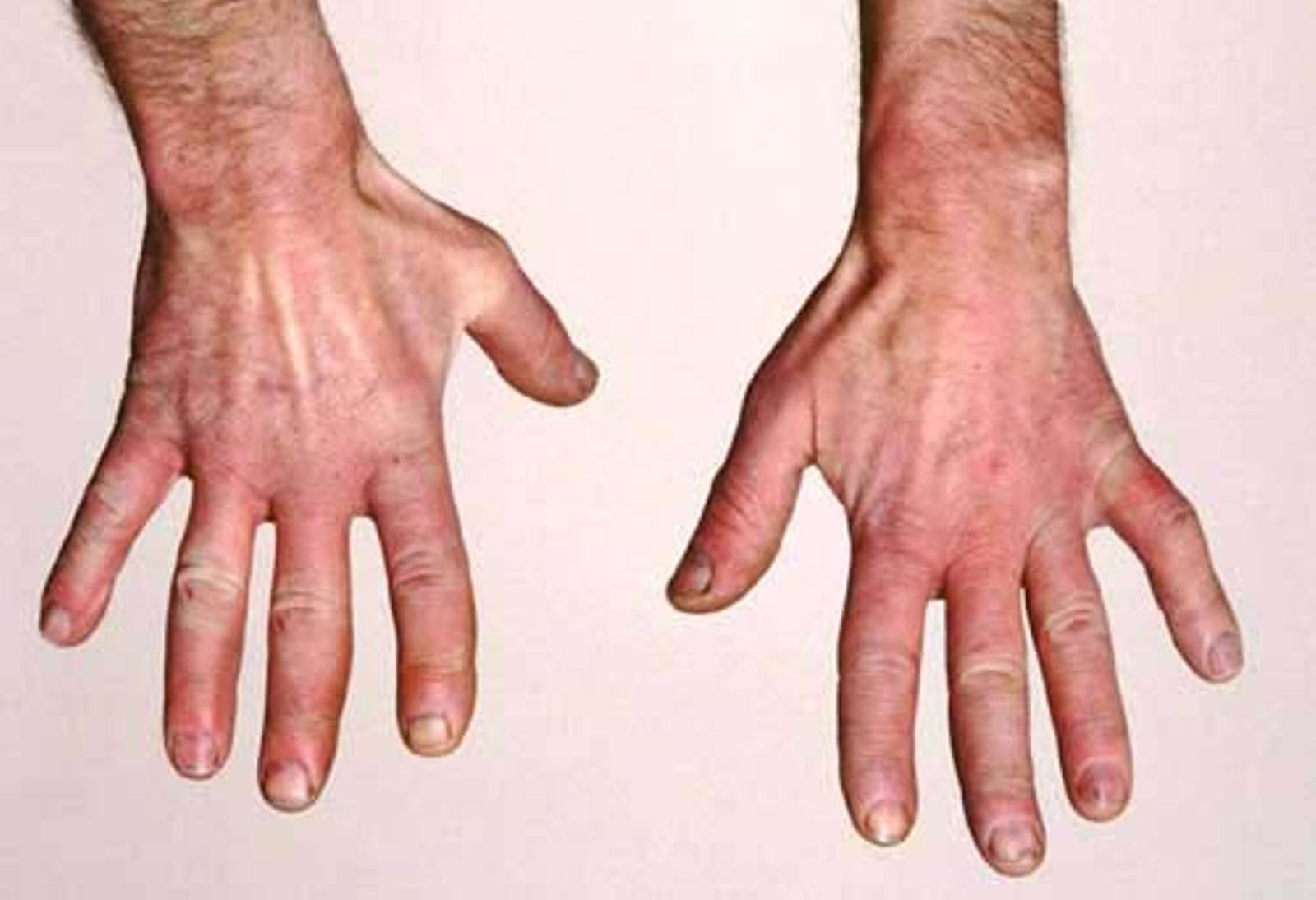 RAYNAUD'S PHENOMENON