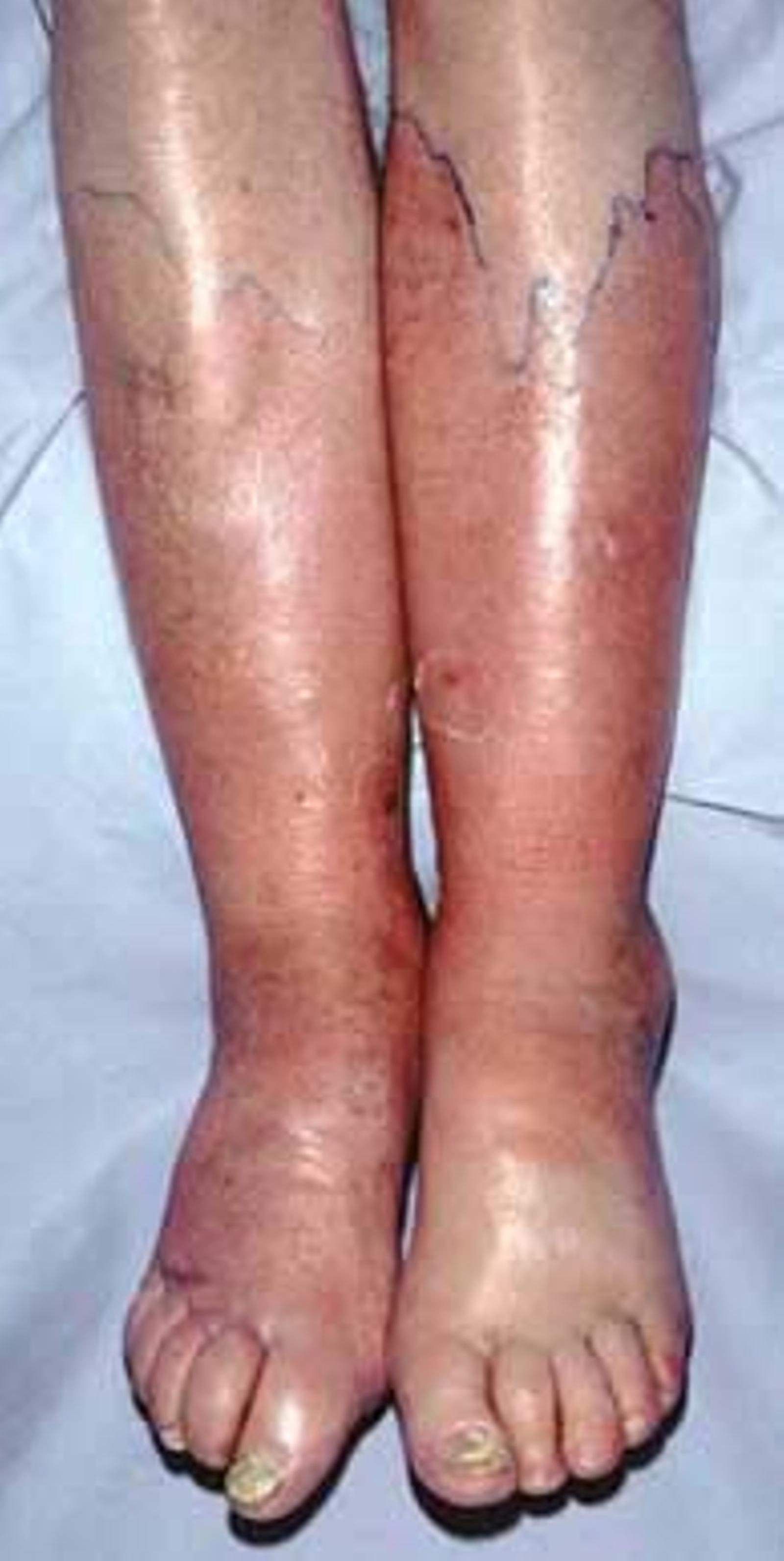 CELLULITIS SHOWING BOTH LEGS