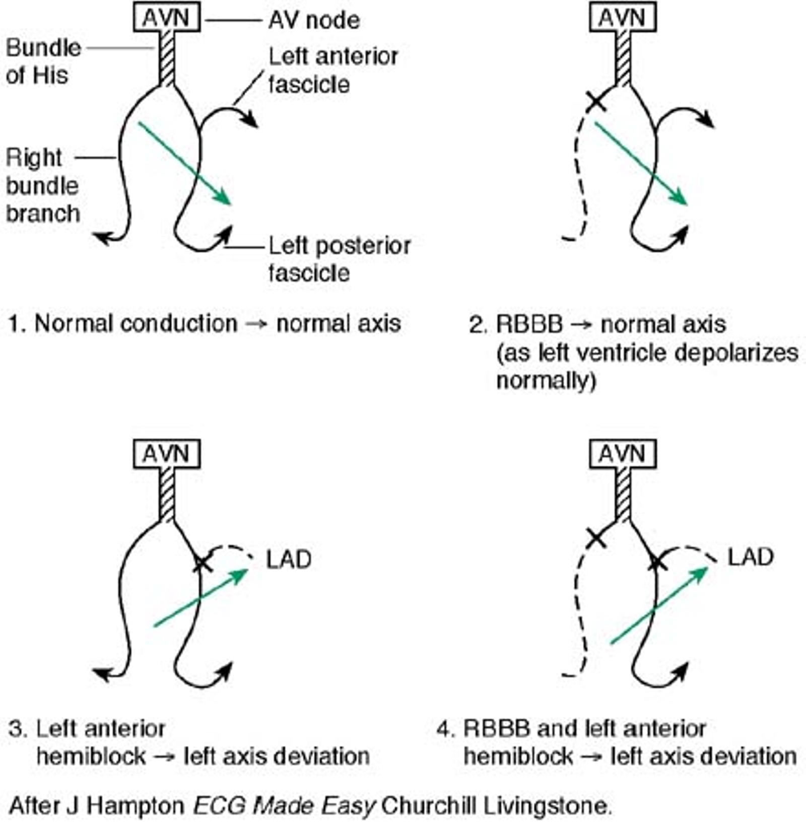 ECG AXIS AND CONDUCTION DEFECTS