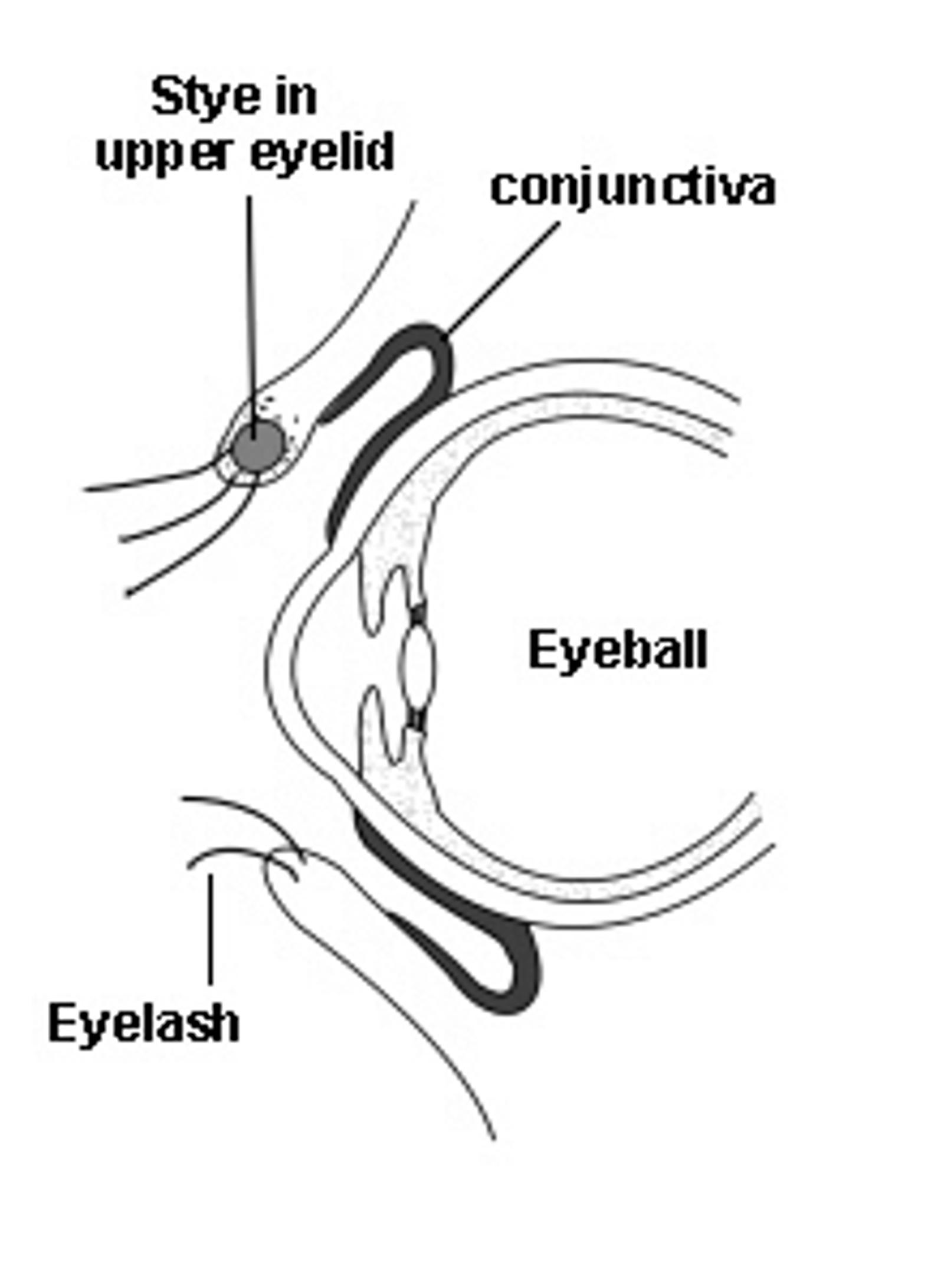 Cross-section diagram of an eye with a stye in the upper eyelid