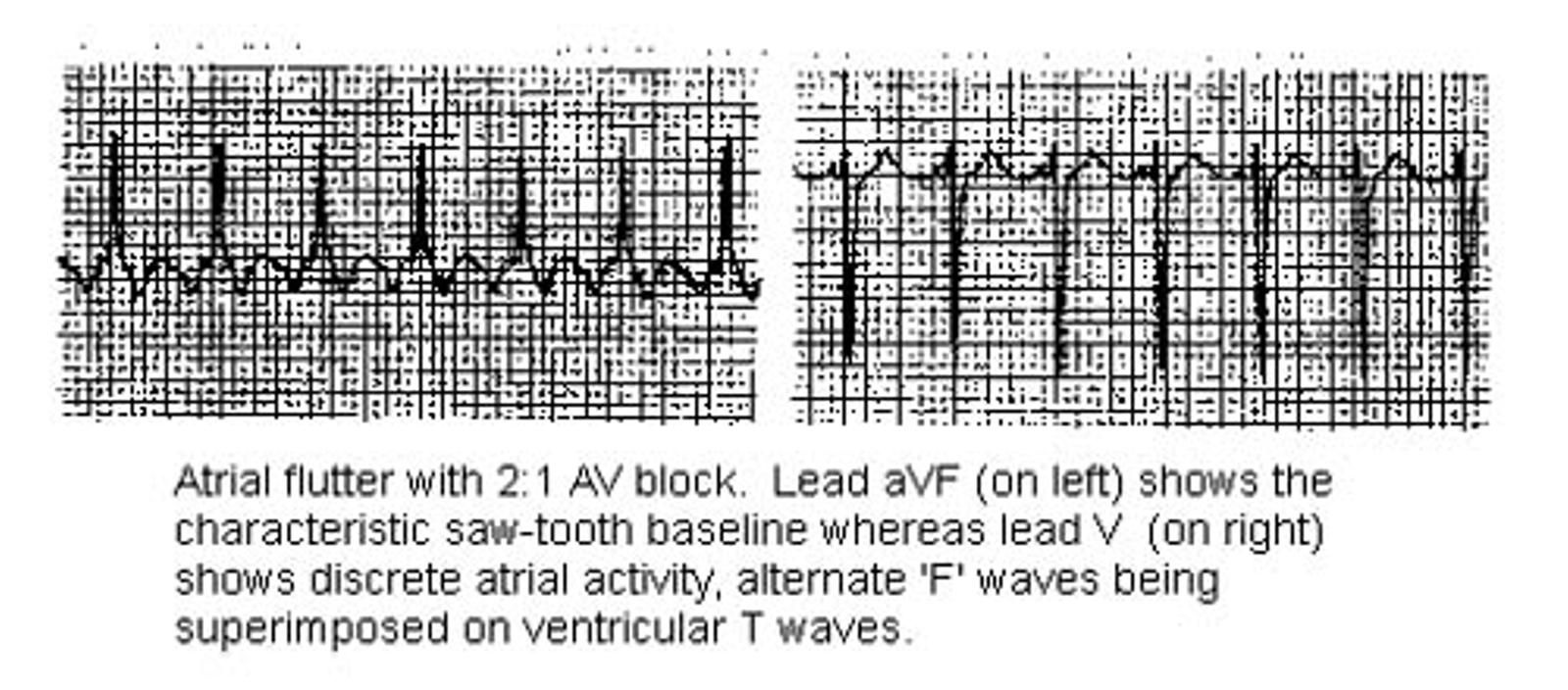 ATRIAL FLUTTER