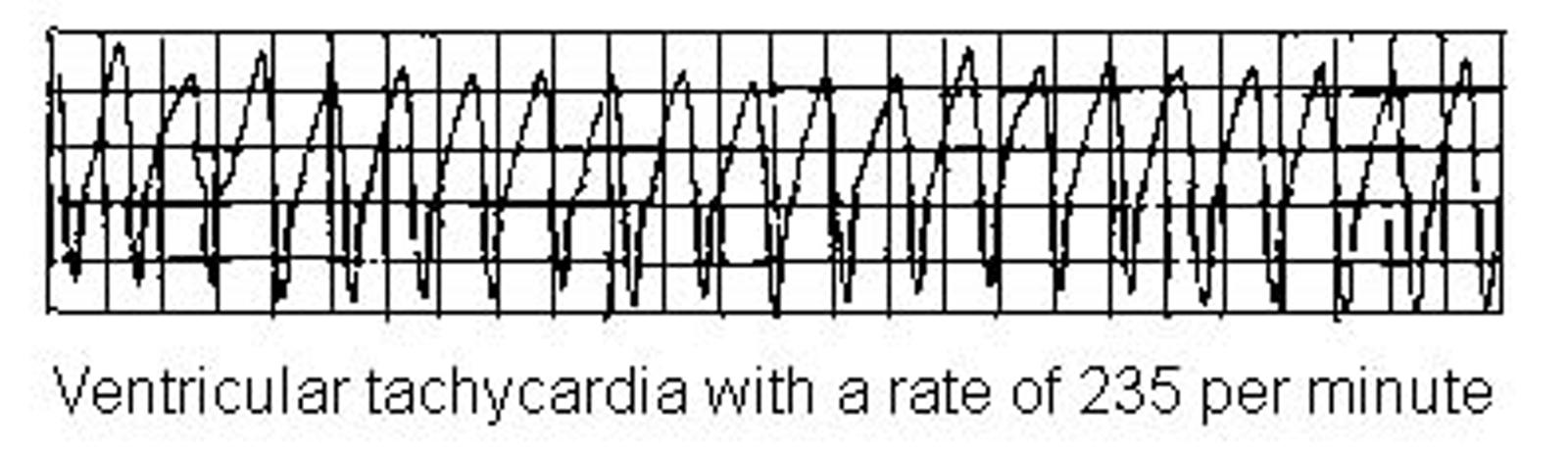 VENTRICULAR TACHYCARDIA