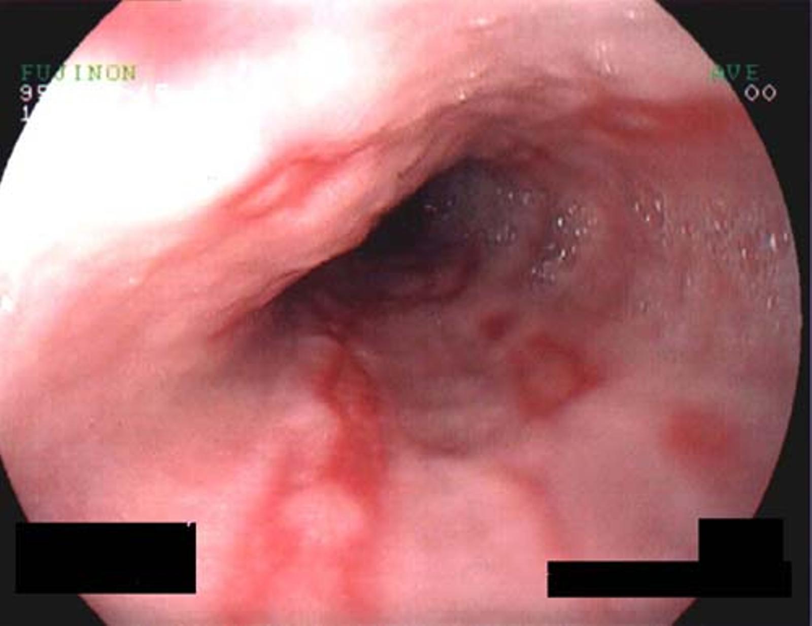 REFLUX OESOPHAGITIS