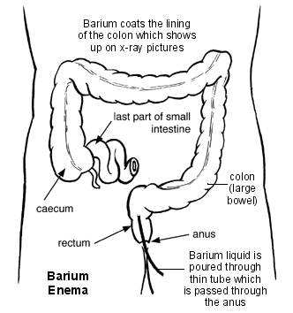 Cross-section diagram showing a barium enema