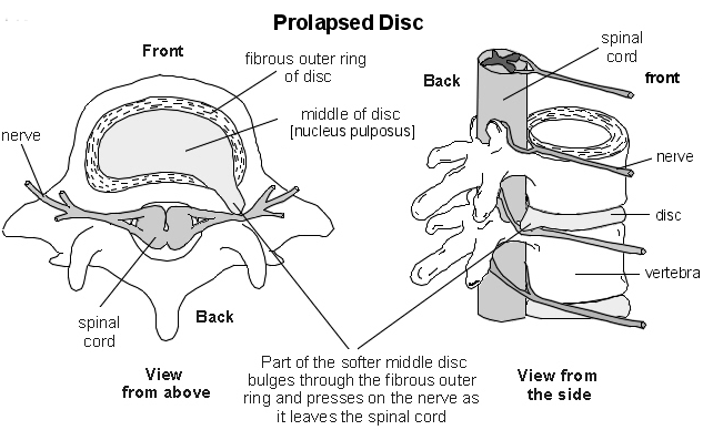 Prolapsed disc