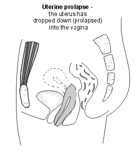 UTERINE PROLAPSE