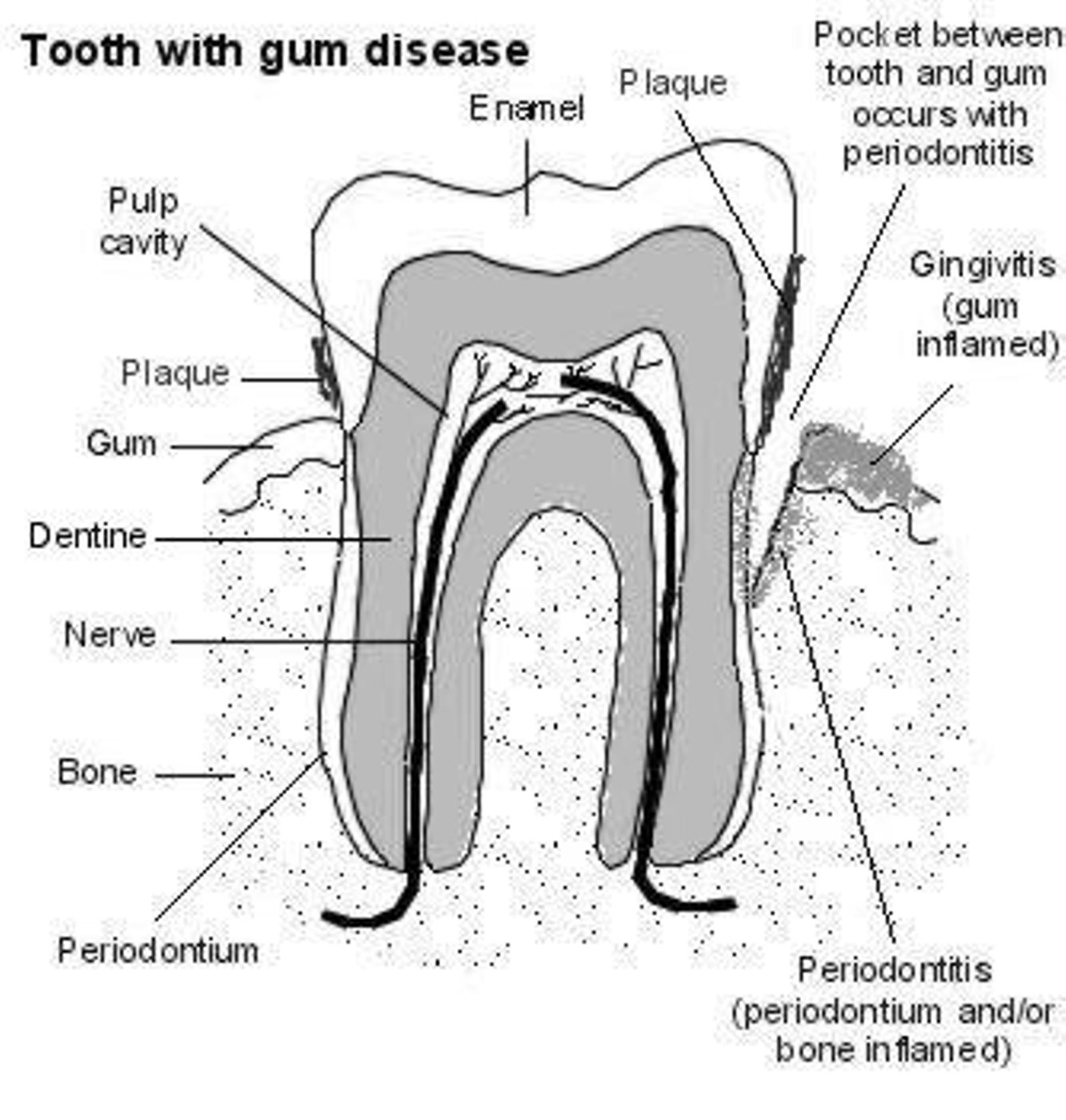 tooth with gum disease