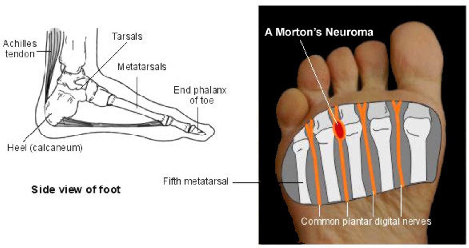 morton's neuroma