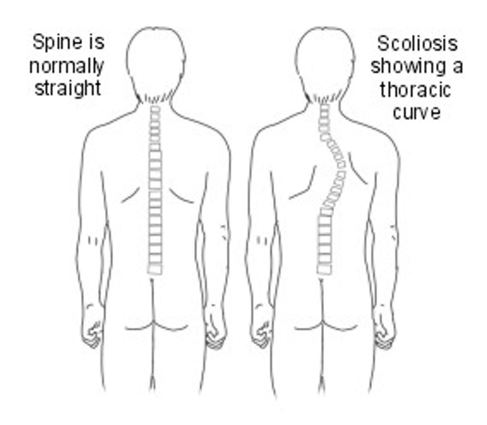 scoliosis