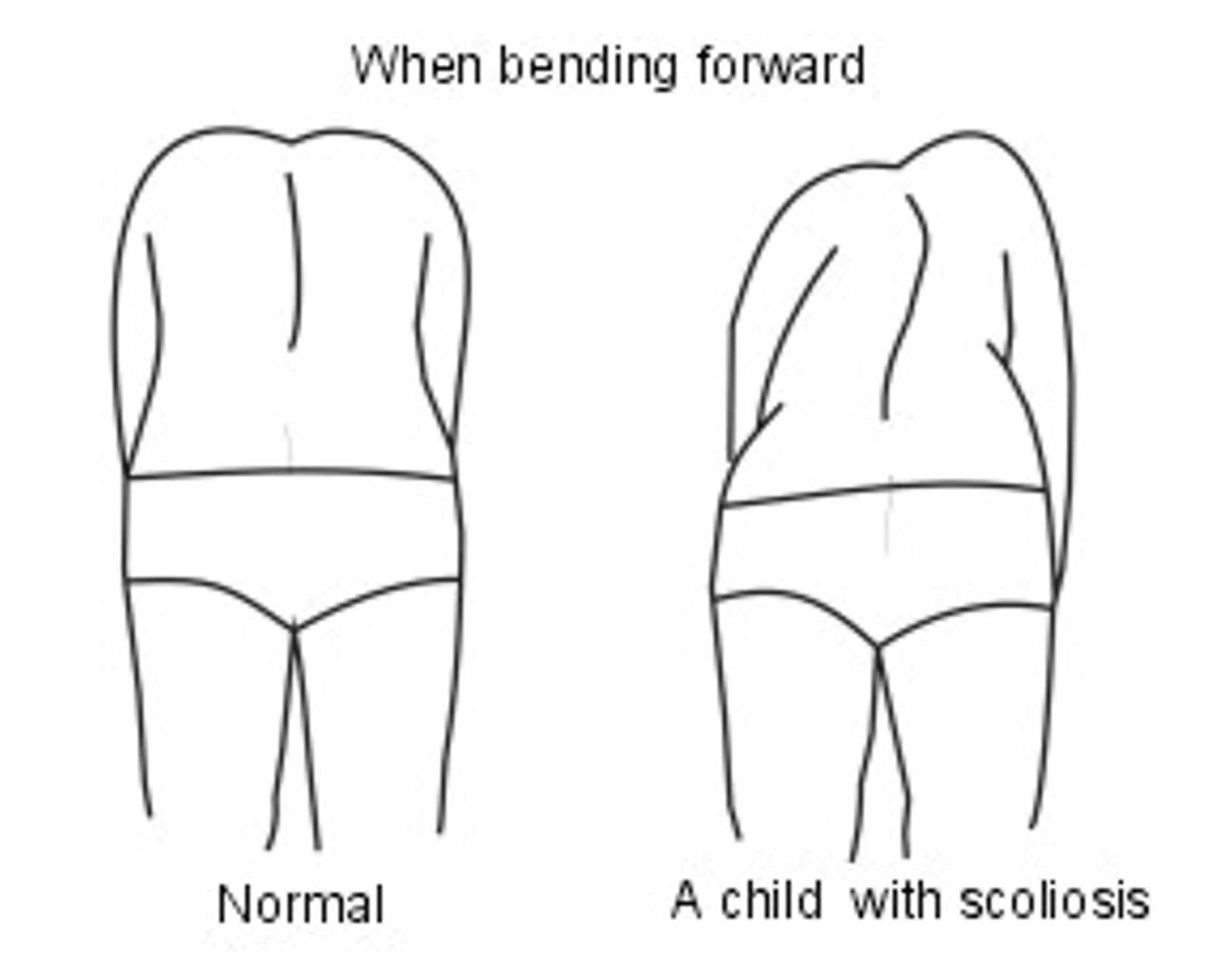 scoliosis diagnosis