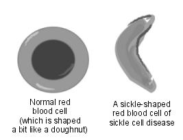 Blood cell normal and sickle shaped