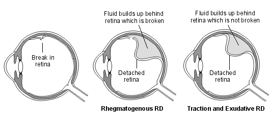 retinal detachment