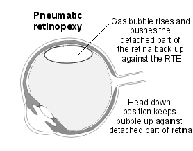 pneumatic retinopexy