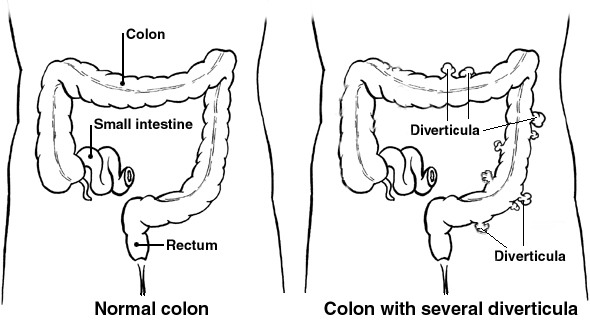 Diverticula