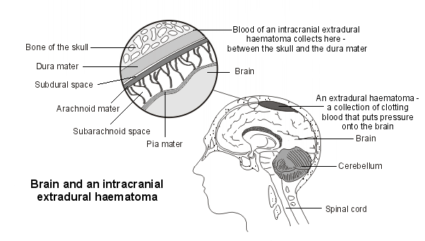 extradural haematoma