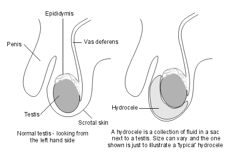 hydrocele