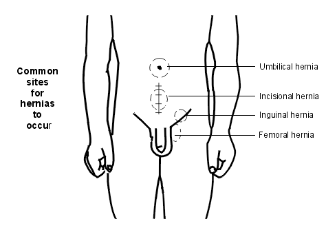 hernia