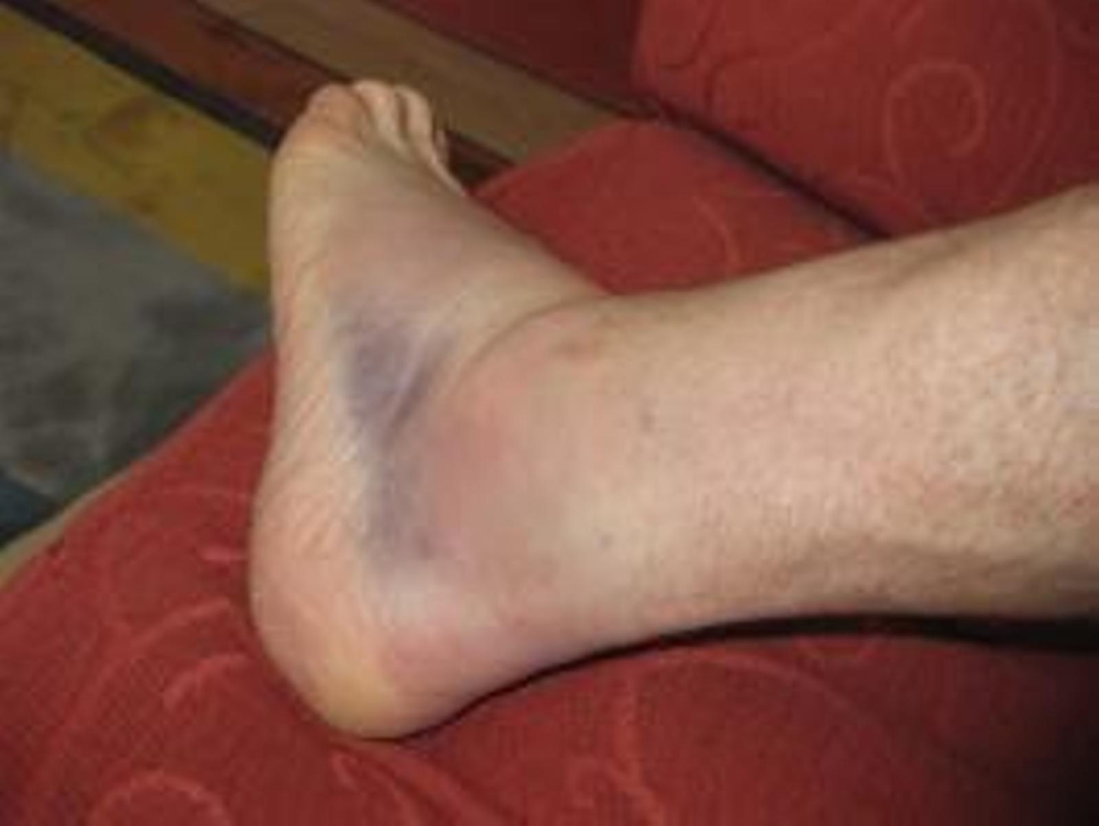 sprained ankle