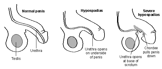 Hypospadias