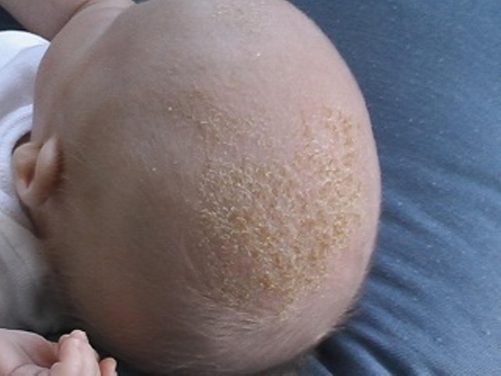 Cradle cap