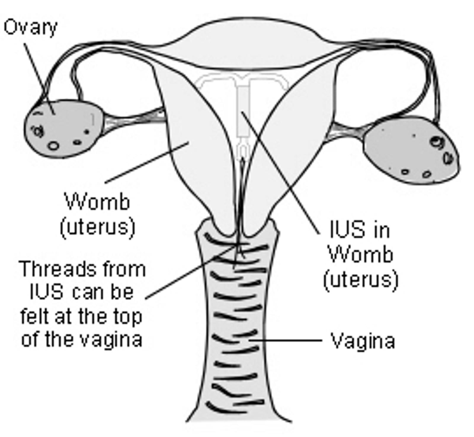 LNG-IUD in place