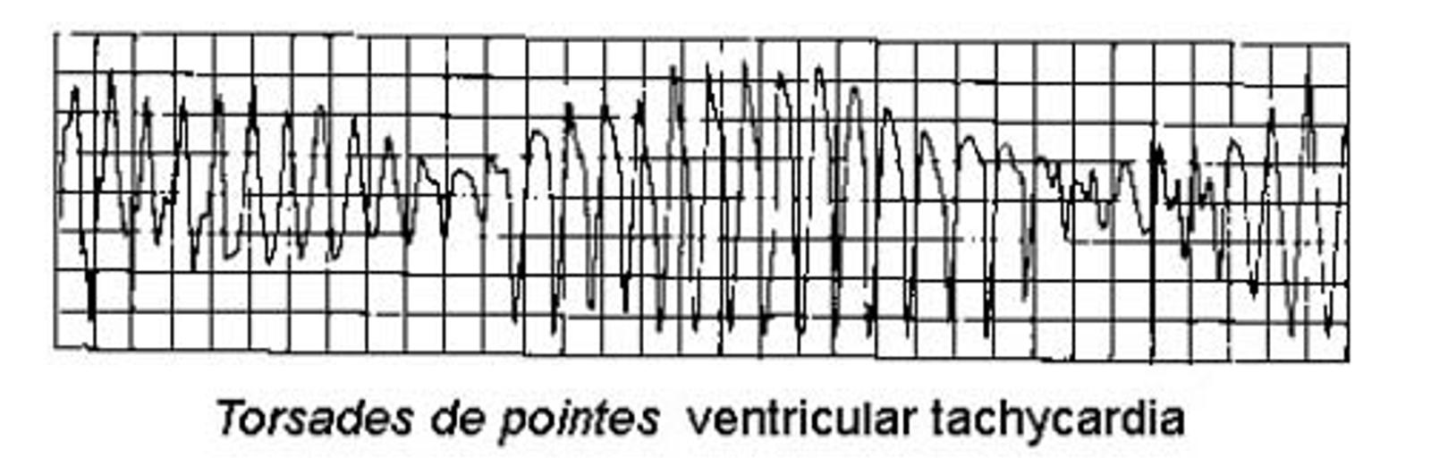 Torsades de pointes VT