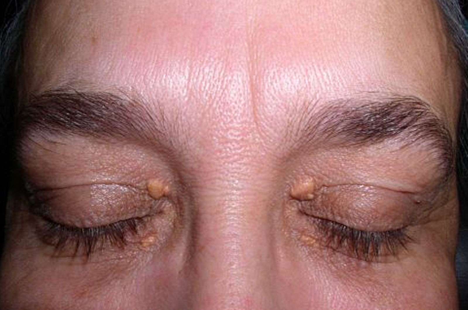 Xanthelasma