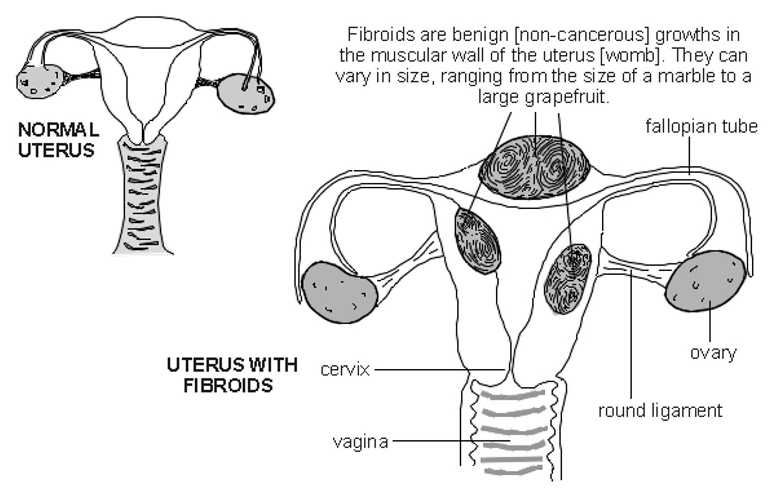 Uterus with fibroids