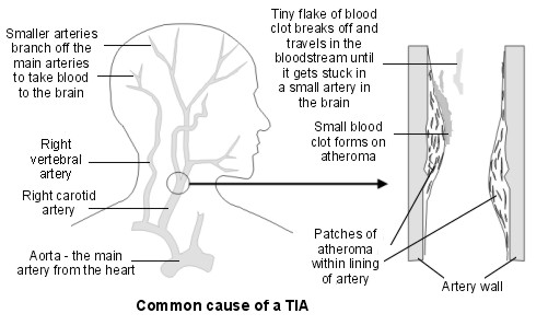 Cross-section diagram showing main arteries of the brain and a TIA blood clot