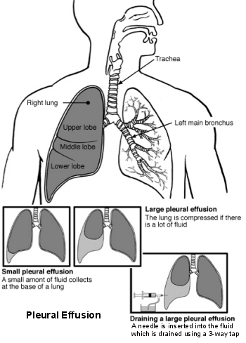 Lungs and airways with pleural effusion