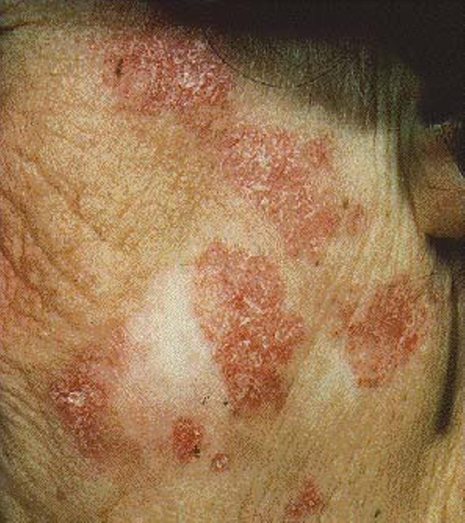 Discoid lupus erythematosus